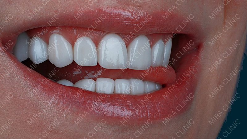 Hollywood Smile Results Look Like